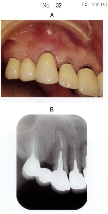 口腔内写真(別冊No.32A)とエックス線画像(別冊No.32B)
