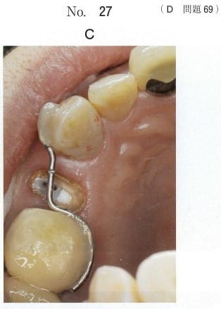 前処置中の口腔内写真(別冊No. 27C)