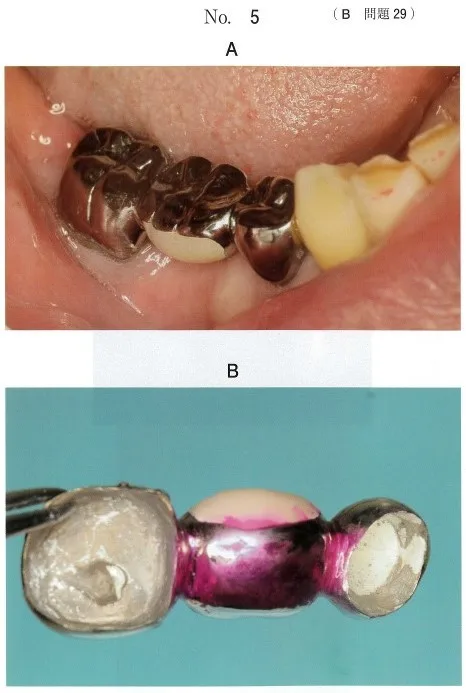 仮着時の口腔内写真(別冊No.5A)と2週後のプラーク染め出し後のブリッジの写真(別冊No.5B)